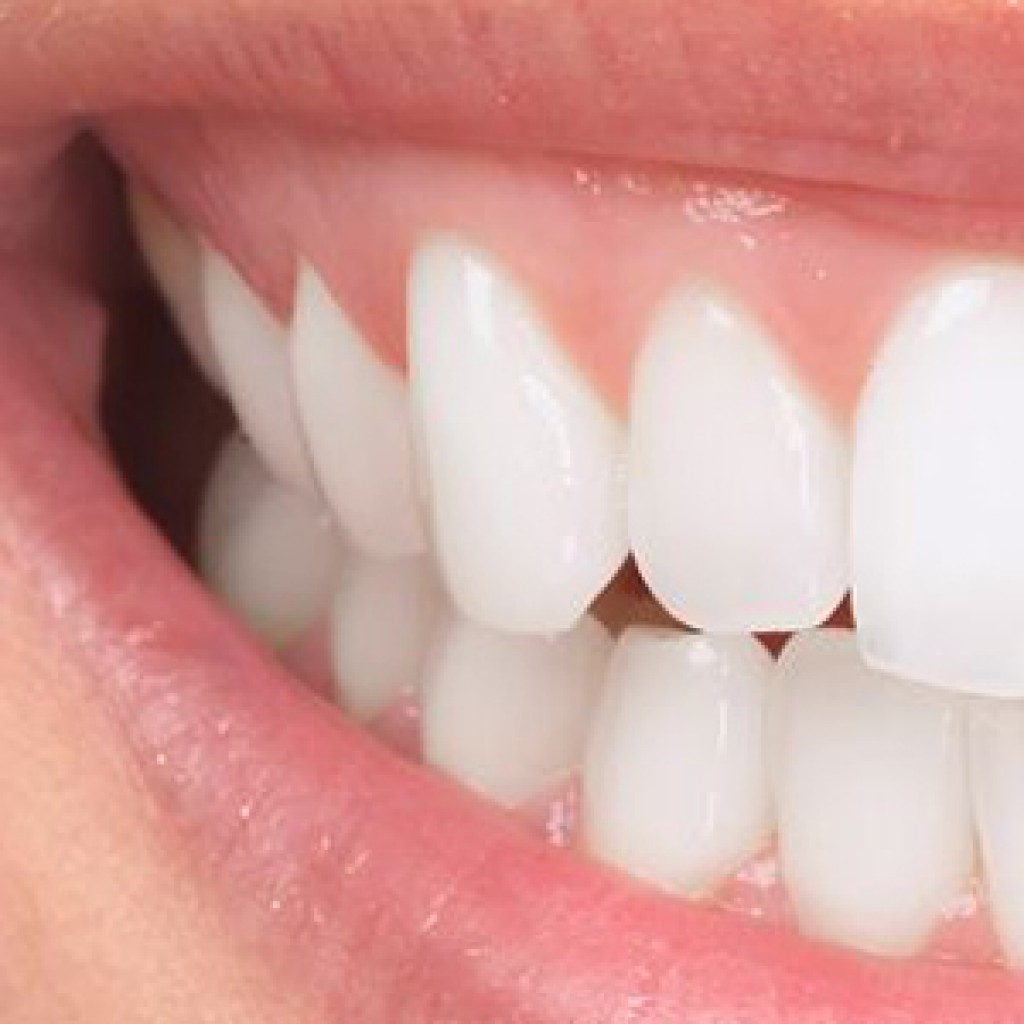 Отбеливание клиновидной дефект зубов
